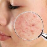 Acne Scar Treatment