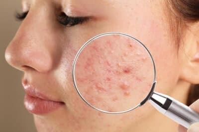 Acne Scar Treatment