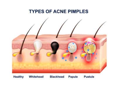 Acne Treatment