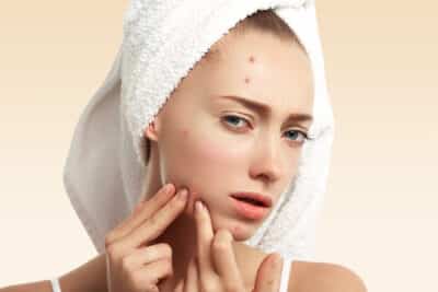 Acne Treatment