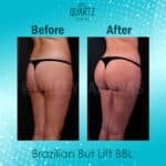 Butt Enhancement