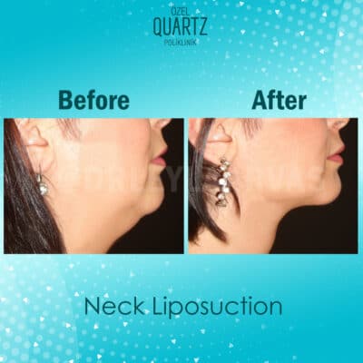 Neck Lift