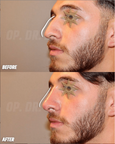 Non Surgical Nose Job