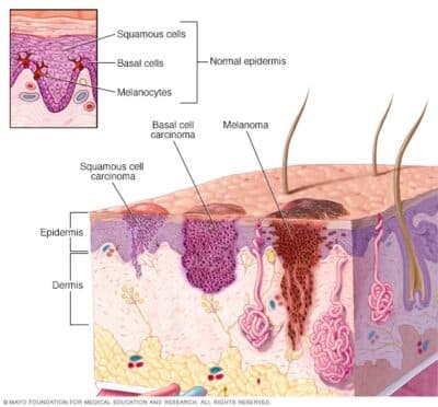 Skin Cancer Symptoms 