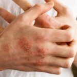 Eczema Treatment