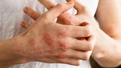 Eczema Treatment