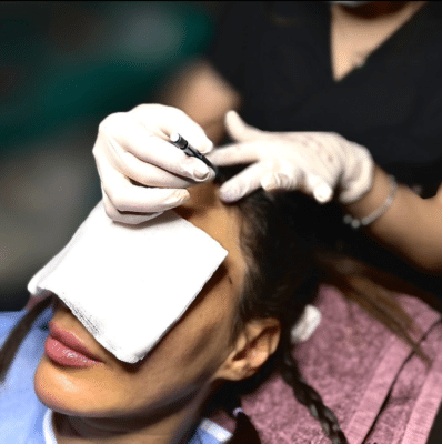 Haartransplantation bei Frauen