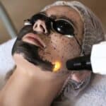 Carbon Laser Facial