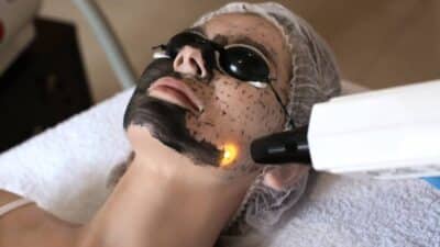 Carbon Laser Facial