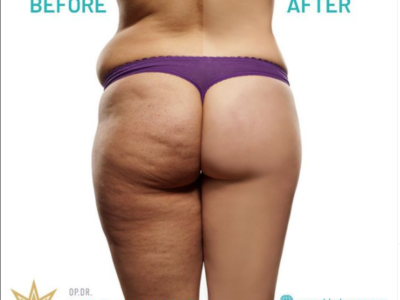 Traitement de la Cellulite