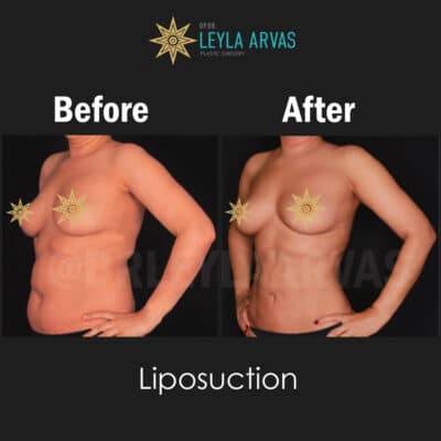 Liposuccion