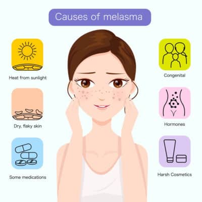 Melasma