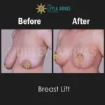 Breast Lift Surgery