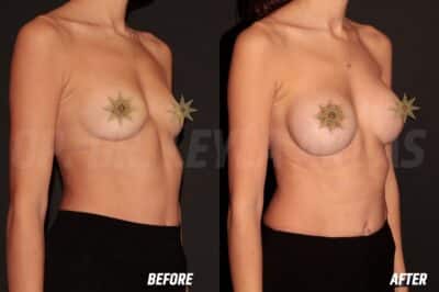 Breast Augmentation 