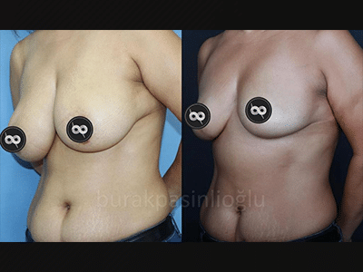 Breast Reduction Surgery