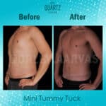 Mini Abdominoplasty