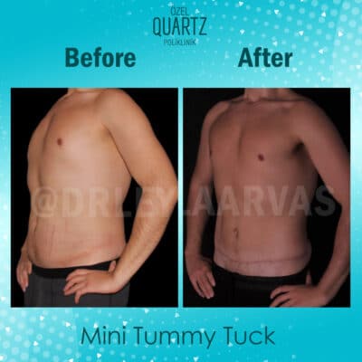 Mini Abdominoplasty 