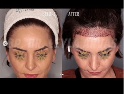 Forehead Reduction Surgery