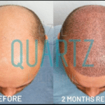 Haartransplantation mit Saphir