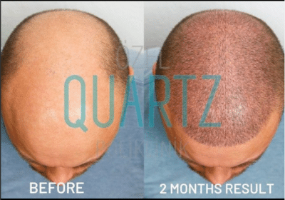 Haartransplantation mit Saphir