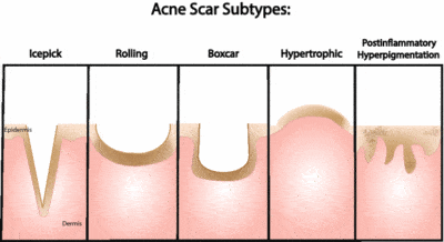 Acne Scar Treatment