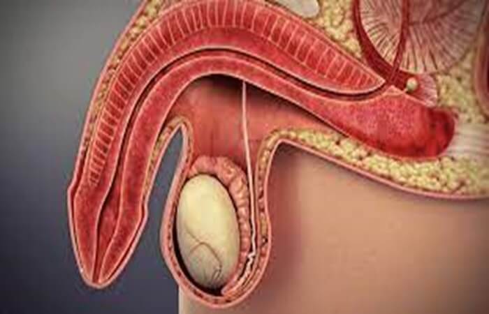 انحناء القضيب - علاج مرض بيروني - كوارتز كلينك - اسطنبول