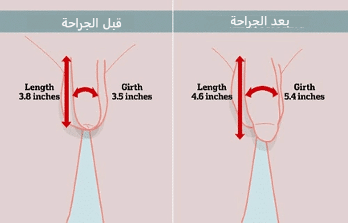 عملية زيادة سماكة القضيب - كوارتز كلينك - اسطنبول