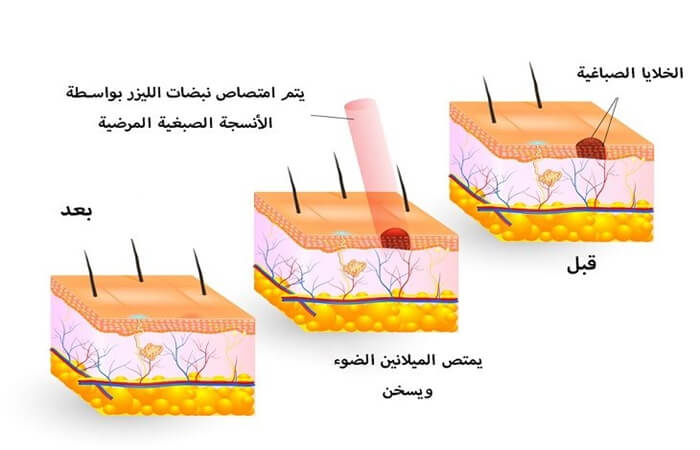 ازالة التصبغات الجلدية بالليزر - كوارتز كلينك - اسطنبول