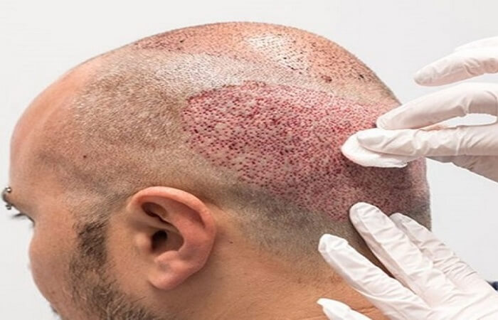 تعليمات بعد عملية زراعة الشعر - كوارتز كلينك - اسطنبول