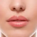 lip lift