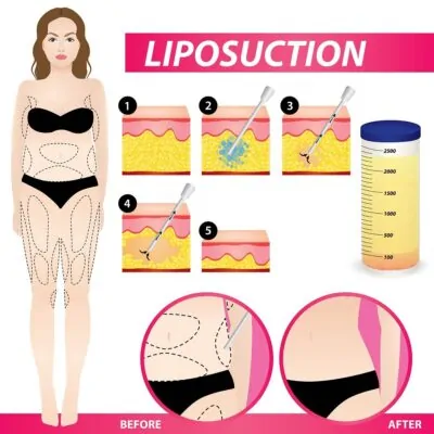 liposuction