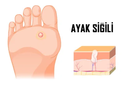 ayak siğili