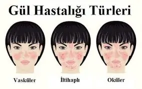 gül hastalığı türleri