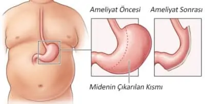 Tüp Mide Ameliyati 