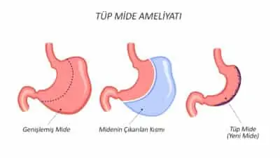 Tüp Mide Ameliyatı