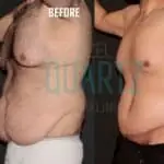 Body Lift Surgery