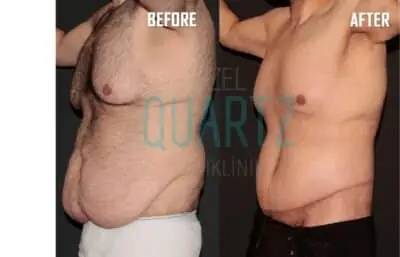 Body Lift Surgery