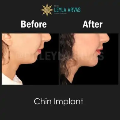 Jaw Implant