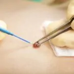 Electrosurgery For Skin Lesions