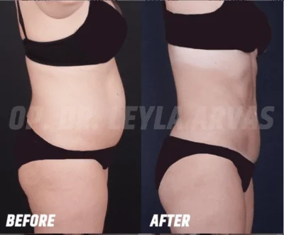 Liposuction (Fat Removal)