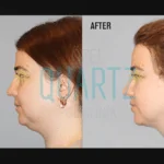 Double Chin Liposuction