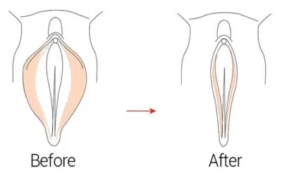 Vulvoplasty