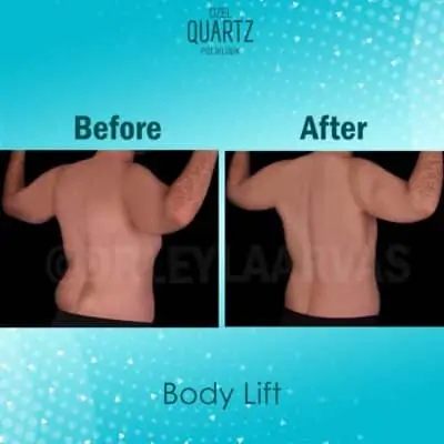 Body Lift Surgery