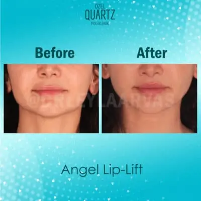 Lip Lift Surgery