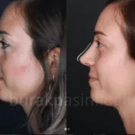 Nose Job Surgery