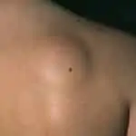 Sebaceous Cyst Treatment