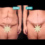 Tummy Tuck Recovery