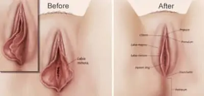 Labiaplasty