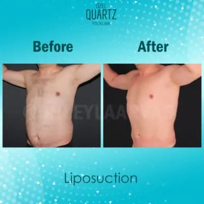 Vaser Liposuction