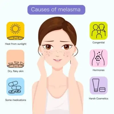 Melasma Treatment